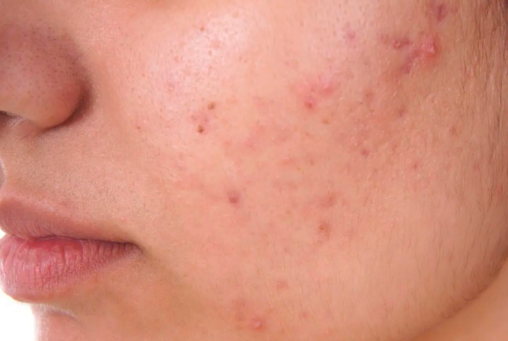 Pimple acne skin
